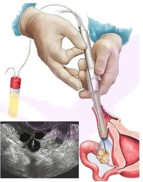 助孕机构推 上海坤和 上海做试管婴儿要多少钱? ‘生男孩的乳晕特征图片’