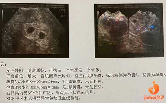 广州世纪助孕中心[供卵等得到吧]+泰国试管婴儿如何生双胎？几点建议告诉你！